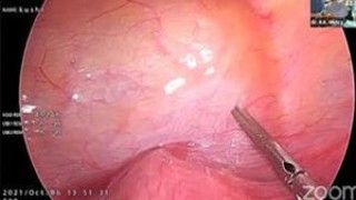 Minimally Invasive Surgery: Simultaneous Cholecystectomy and Appendectomy through a Single Incision