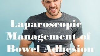 Live video of Laparoscopic Management of Small Bowel Adhesion
