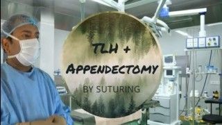 Laparoscopic Hysterectomy By Ligation of Uterine Artery and Simultaneous Appendectomy