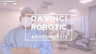 Davinci Robotic Adhesiolysis Surgery with Application of Interceed