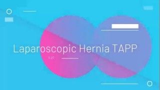 Laparoscopic Hernia Repair Large Sac TAPP Repair