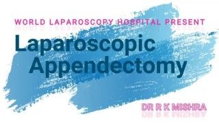 Laparoscopic Appendectomy for Acute Appendicitis (Retrocecal Appendix)