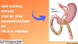 Mini Gastric Bypass Surgery Full Video Skin to Skin by Dr. R.K. Mishra