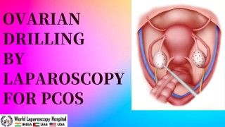 Ovarian Drilling by Laparoscopy for PCOS