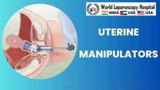 Uterine Manipulators: Understanding the Importance of this Essential Surgical Tool