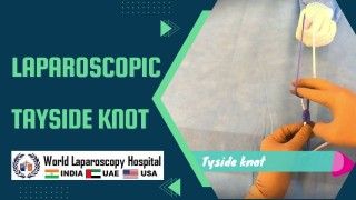 Laparoscopic Management of Ruptured Appendix