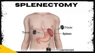 Laparoscopic Myomectomy and Salpingectomy