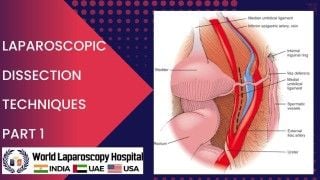 Standard Laparoscopic Cholecystectomy