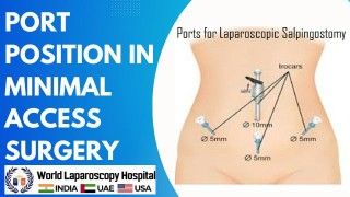 Dr R K Mishra Explaining Laparoscopic Appendicectomy