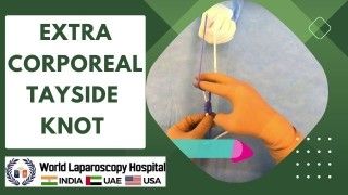 Mastering the Extra Corporeal Tayside Knot: Advanced Laparoscopic Suturing Techniques