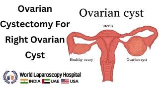 Surgical Solution for Ovarian Cysts: Ovarian Cystectomy for Right Ovarian Cyst