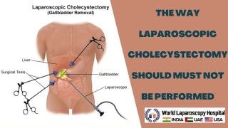 The Right Way to Perform Laparoscopic Cholecystectomy: Avoiding Common Mistakes