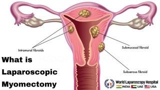 Laparoscopic Myomectomy: A minimally invasive approach to remove uterine fibroids