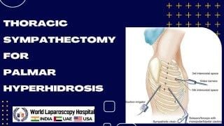 Stopping the Sweat: Thoracic Sympathectomy for Palmar Hyperhidrosis