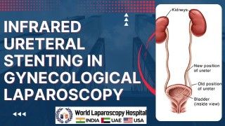 Maximizing Safety and Precision: Infrared Ureteral Stenting in Gynecological Laparoscopy