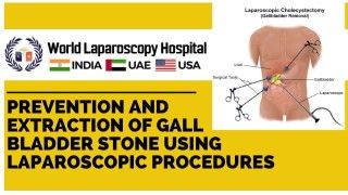 Difficult Laparoscopic Cholecystectomy performed by Pledget Dissection of Calot's triangle