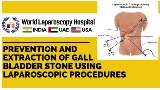 Experience innovative laparoscopic techniques for gall bladder stone prevention