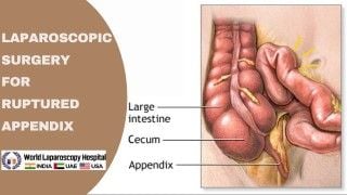 Total laparoscopic hysterectomy (TLH) in patients with previous cesarean section