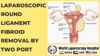 Laparoscopic Management of Chronic Ectopic and Myomectomy in same patient