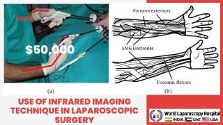 Laparoscopic Oophorectomy for Ovarian Torsion • Video •