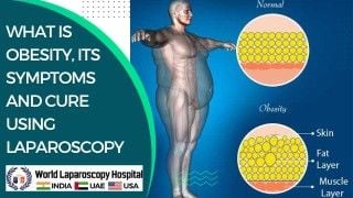 Laparoscopic Surgery for Obesity: Understanding Symptoms and Treatment Options