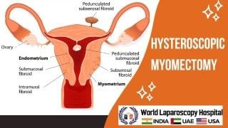 Laparoscopic Surgery for Left Ovarian Dermoid Cyst