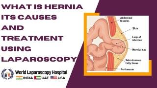 IPOM Inguinal Hernia Surgery