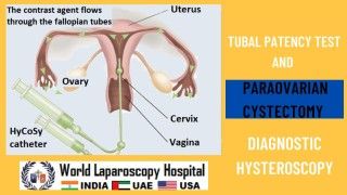 Diagnostic Hysteroscopy, Tubal Patency Test, and Paraovarian Cystectomy Unveiled