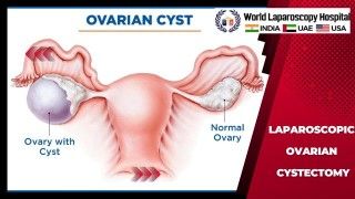 Laparoscopic Ovarian Cystectomy: Minimally Invasive Precision Surgery