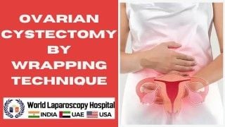 Total Laparoscopic Hysterectomy for Very Large Uterus with Huge Fibroid