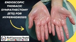 Minimally invasive relief for Hyperhidrosis: Endoscopic Thoracic Sympathectomy(ETS)