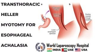 Restoring swallowing function: Transthoracic Heller Myotomy offers relief for Esophageal Achalasia