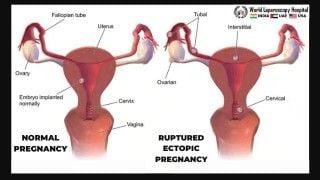 Urgent intervention for a ruptured ectopic pregnancy: Preventing life-threatening complications