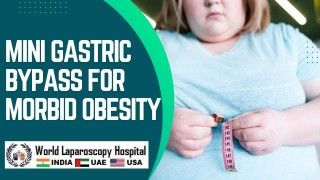 Transforming Lives: Mini Gastric Bypass Offers Hope for Morbid Obesity