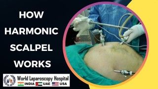 Laparoscopic Inguinal Hernia Surgery Explained Step by Step