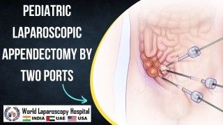 Revolutionizing Pediatric Surgery: Two-Port Laparoscopic Appendectomy