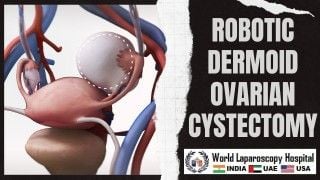 Robotic Dermoid Ovarian Cystectomy for Optimal Surgical Outcomes