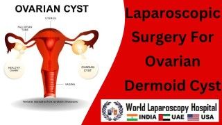 Minimally Invasive Marvel: Laparoscopic Surgery for Ovarian Dermoid Cyst
