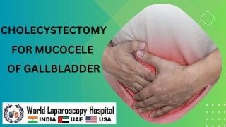 Cholecystectomy for Mucocele of the Gallbladder, Ensuring Optimal Gallbladder Health