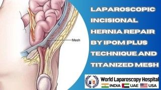 Advanced Hernia Repair: Laparoscopic IPOM Plus Technique with Titanized Mesh for Incisional Hernia