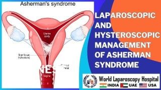 Laparoscopic and Hysteroscopic Management: Effective Treatment for Asherman Syndrome