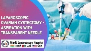 Ovarian Cyst Removal: Laparoscopic Ovarian Cystectomy with Transparent Needle Aspiration