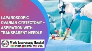 Ovarian Cyst Removal: Laparoscopic Ovarian Cystectomy with Transparent Needle Aspiration