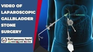 Laparoscopic Myomectomy for Large Fibroid Uterus and Cholecystectomy in same patient by Three Port.