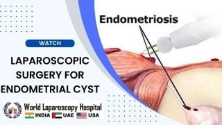 Advancing Women's Health: Laparoscopic Surgery for Endometrial Cyst Treatment