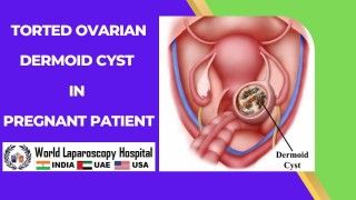Managing Torted Ovarian Dermoid Cyst in Pregnant Patients: A Multidisciplinary Approach