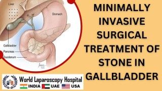 Revolutionizing Gallbladder Stone Treatment: Exploring Minimally Invasive Surgical Techniques