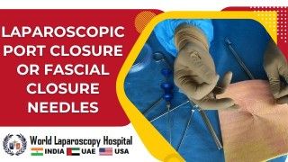 Laparoscopic Cholecystectomy for Stump Cholecystitis