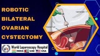 Revolutionizing Gynecological Surgery: Robotic Bilateral Ovarian Cystectomy offers precision