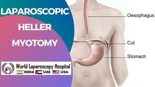 Laparoscopic Cholecystectomy for Short Cystic Duct by Mishra's Knot